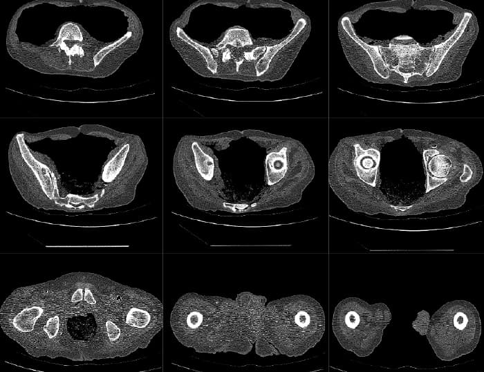 Mako partial knee CT scan