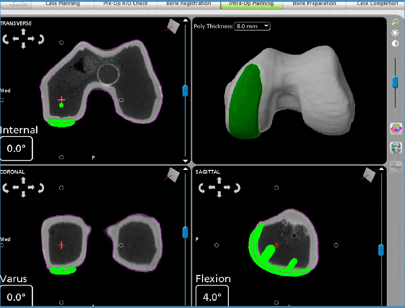 Mako partial knee CT scan